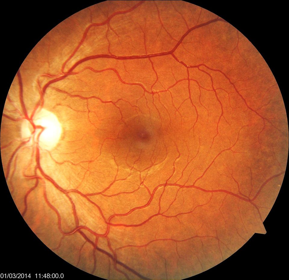 normal retina