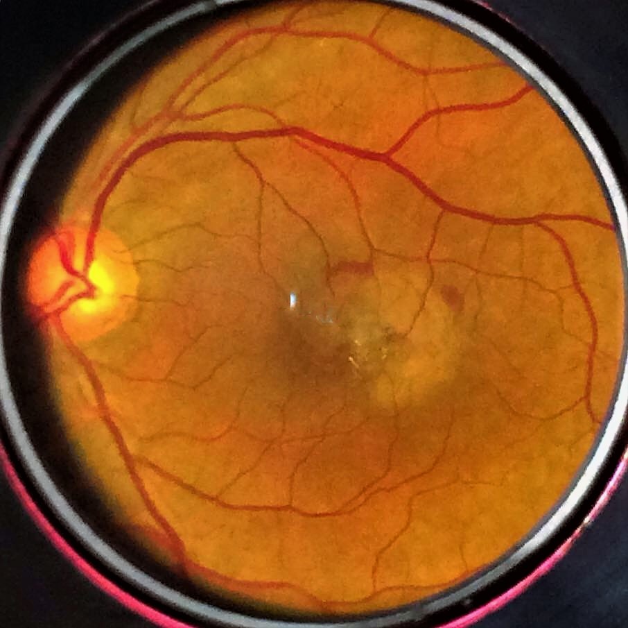 Wet age related macular degeneration abhigna eye and vertigo hospital